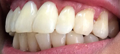 Close-up view of a person’s clean, white teeth showcasing oral health
