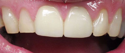Close-up view of clean, white teeth and healthy pink gums