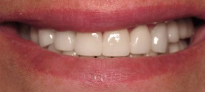 Close-up image of a person’s healthy, white teeth showcased in a smile