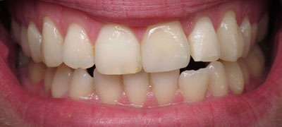 Close-up view of a person’s smile with healthy white teeth