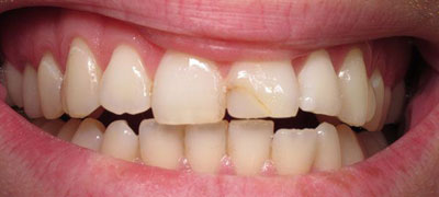 Close-up view of a person’s smile showcasing teeth with slight discoloration