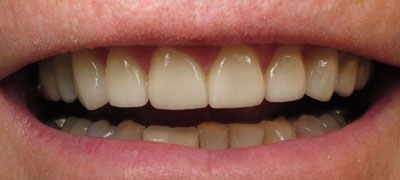 Close-up view of a person’s clean, white, well-aligned teeth with a dark background