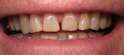Close-up view of a person’s smile showcasing healthy teeth.