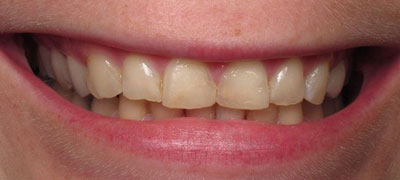 close-up view of person smile and teeth