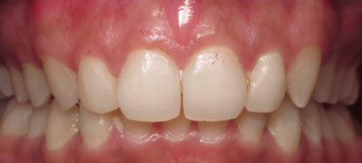 Close-up view of a person’s clean, white teeth and healthy pink gums.