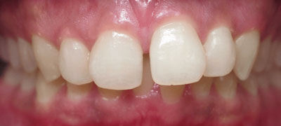 Close-up view of a healthy set of human teeth showcasing dental hygiene