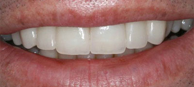 Close-up image of a person’s bright and healthy smile showcasing white teeth.