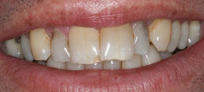 Close-up view of a person’s teeth with visible plaque