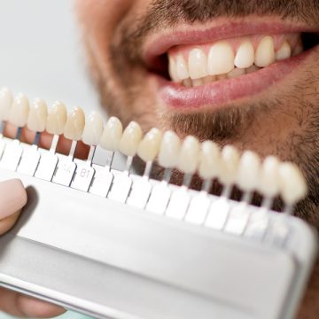 Porcelain Veneers: All You Need to Know