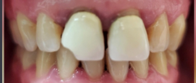 Close-up view of teeth showing difference between yellowed and whitened teeth