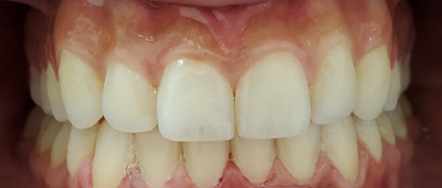 Close-up view of clean, white teeth and healthy gums