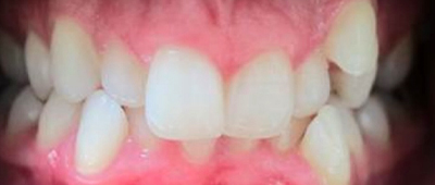 Close-up view of a person’s clean, healthy white teeth and gums.