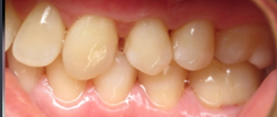 Close-up view of healthy upper teeth and gums