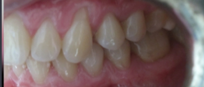 Close-up view of a set of clean, healthy adult teeth