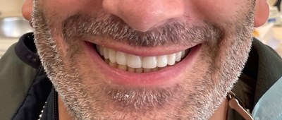 Close view of a person smile and teeth