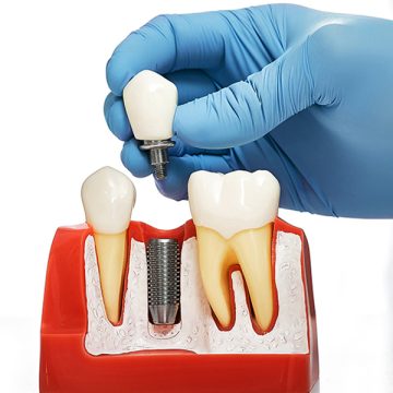 What to Expect Before, During, and After Dental Implant Surgery
